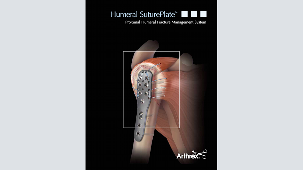 Humeral SuturePlate™ - Proximal Humeral Fracture Management System
