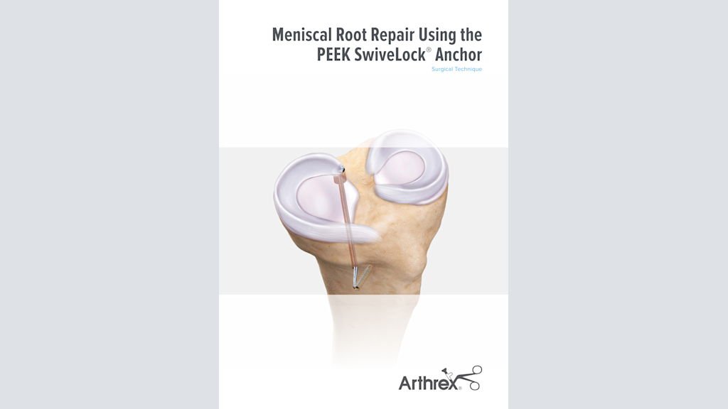 Meniscal Root Repair Using the PEEK SwiveLock® Anchor