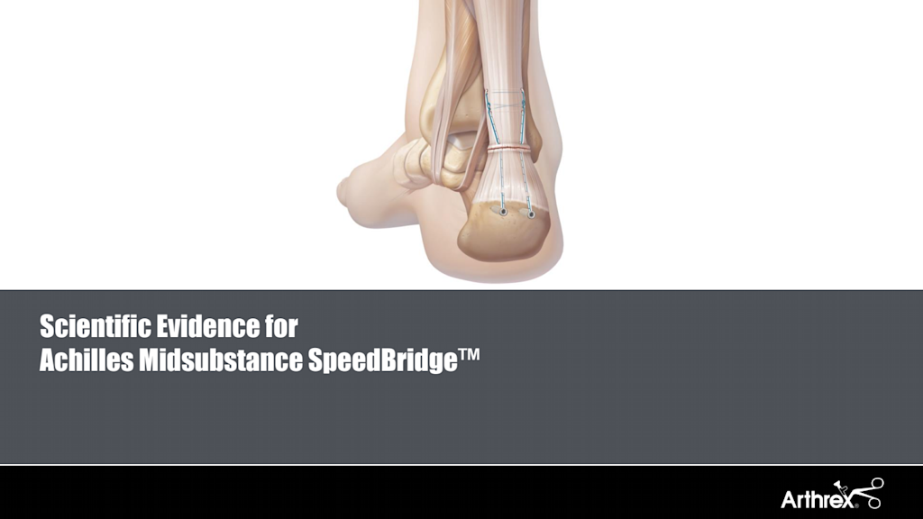 Scientific Evidence for Achilles Midsubstance SpeedBridge™