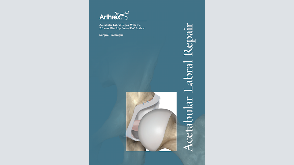 Acetabular Labral Repair with the 2.0 mm Mini Hip SutureTak® Anchor