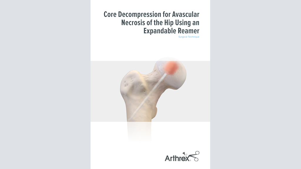 Core Decompression for Avascular Necrosis of the Hip Using an Expandable Reamer