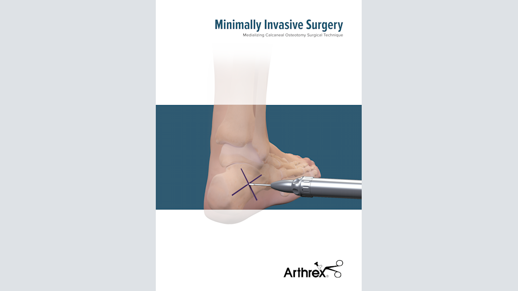 Minimally Invasive Surgery - Medializing Calcaneal Osteotomy Surgical Technique