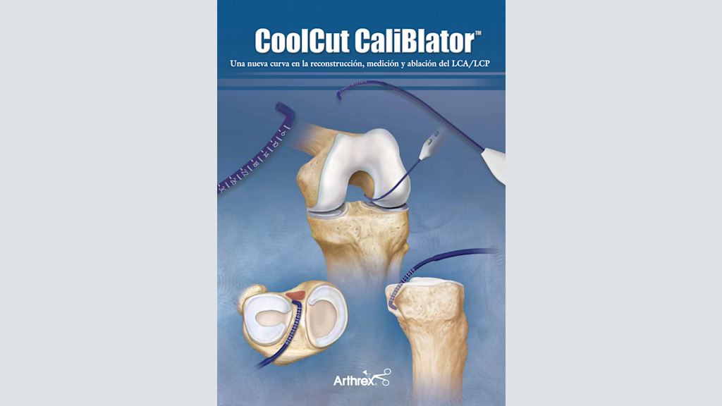 CoolCut CaliBlator™. Una nueva curva en la reconstrucción, medición y ablación del LCA/LCP