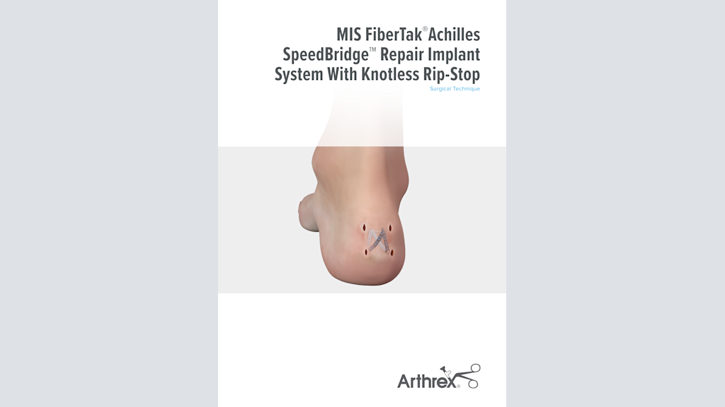 MIS FiberTak® Achilles SpeedBridge™ Repair Implant System With Knotless Rip-Stop 