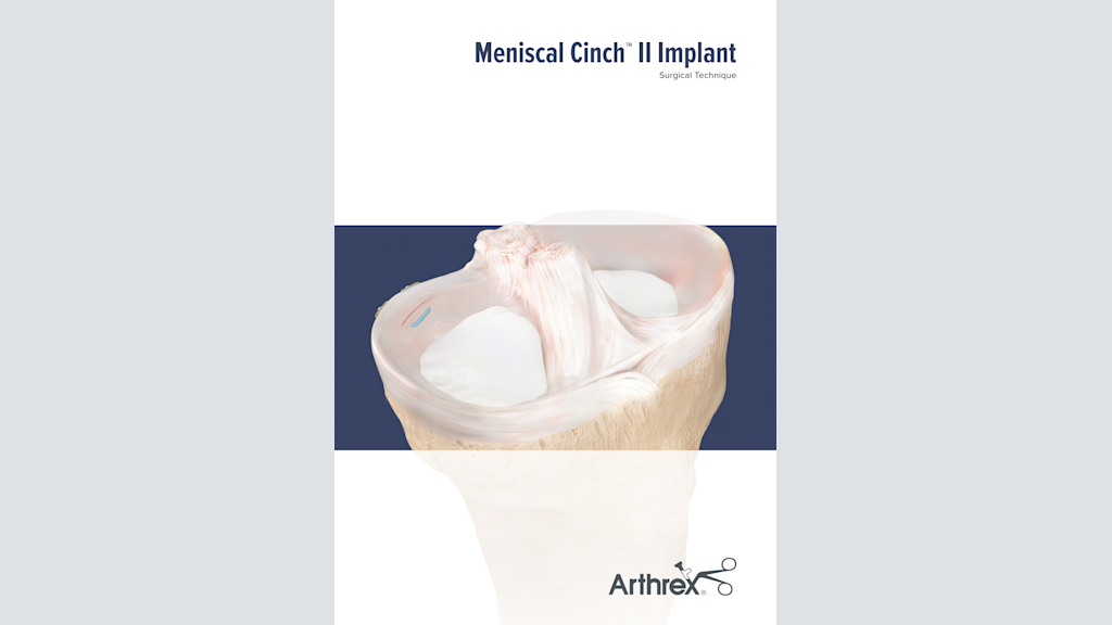 Meniscal Cinch™ II Implant