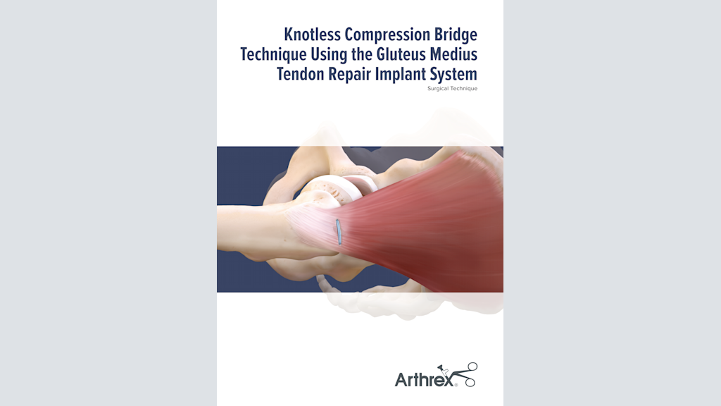 Knotless Compression Bridge Technique Using the Gluteus Medius Tendon Repair Implant System
