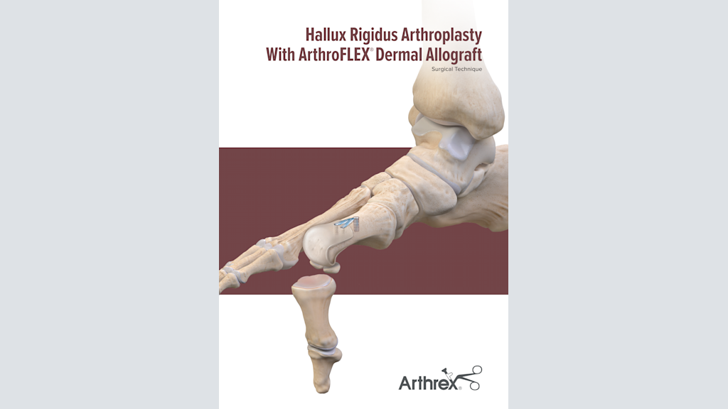 Hallux Rigidus Arthroplasty With ArthroFLEX® Dermal Allograft