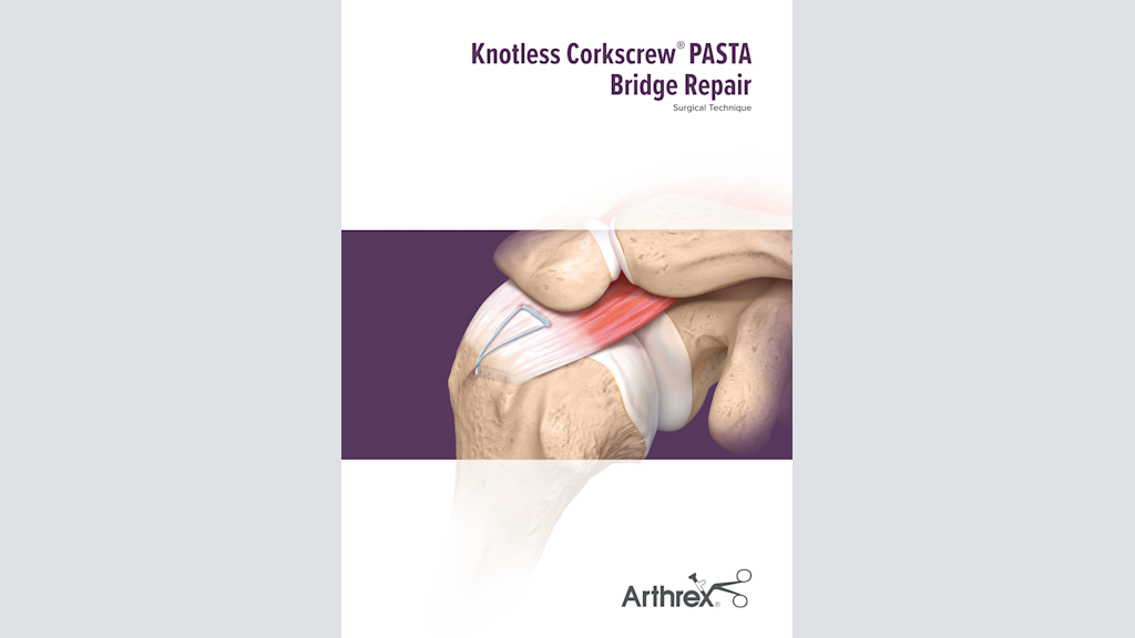 Knotless Corkscrew® PASTA Bridge Repair