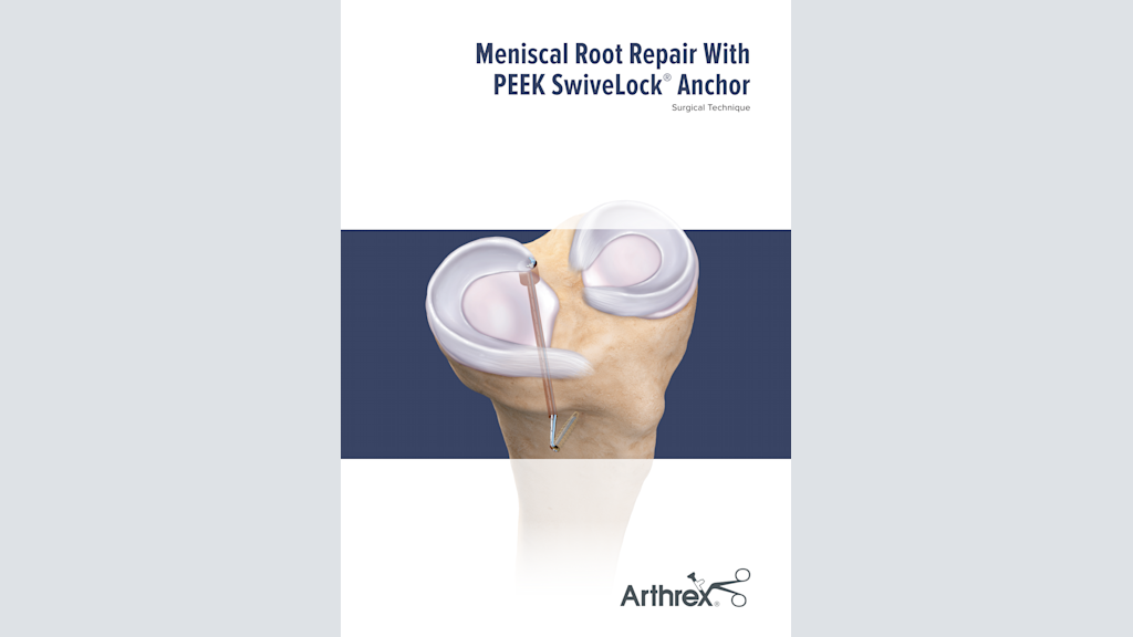 Meniscal Root Repair With PEEK SwiveLock® Anchor