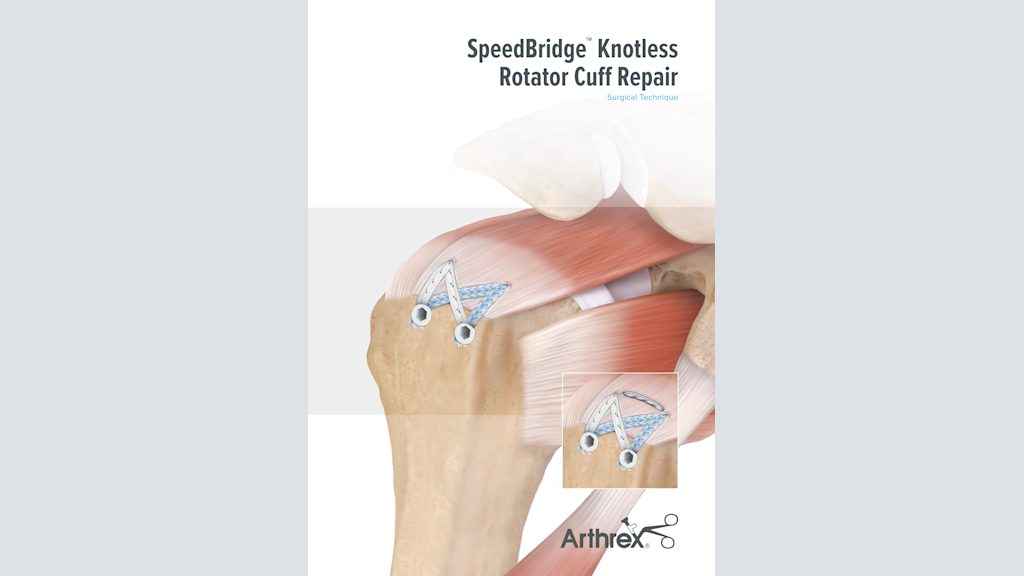 SpeedBridge™ Knotless Rotator Cuff Repair