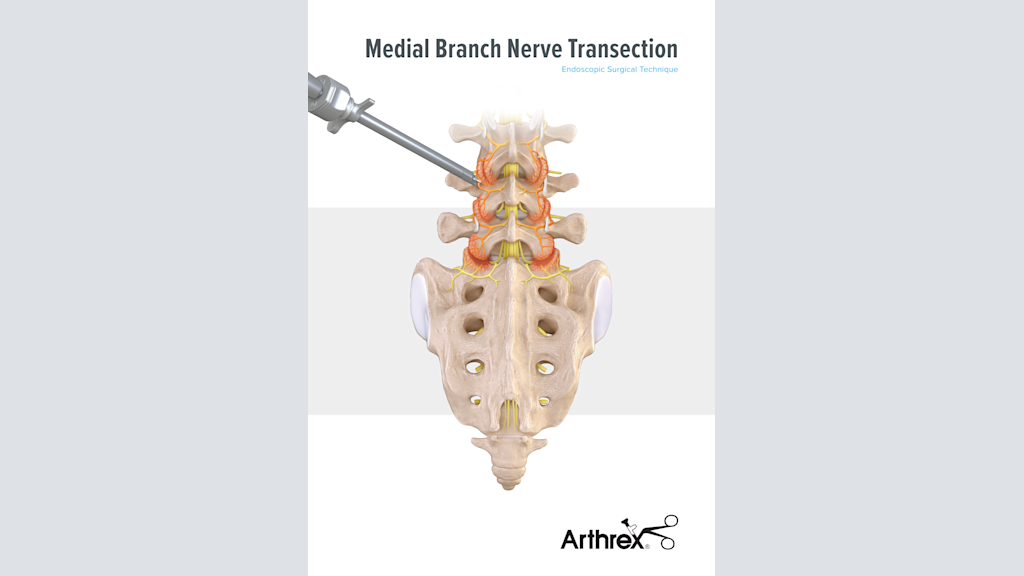 Medial Branch Nerve Transection