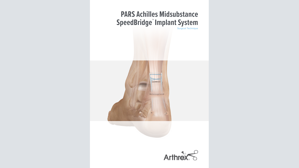 PARS Achilles Midsubstance SpeedBridge™ Implant System