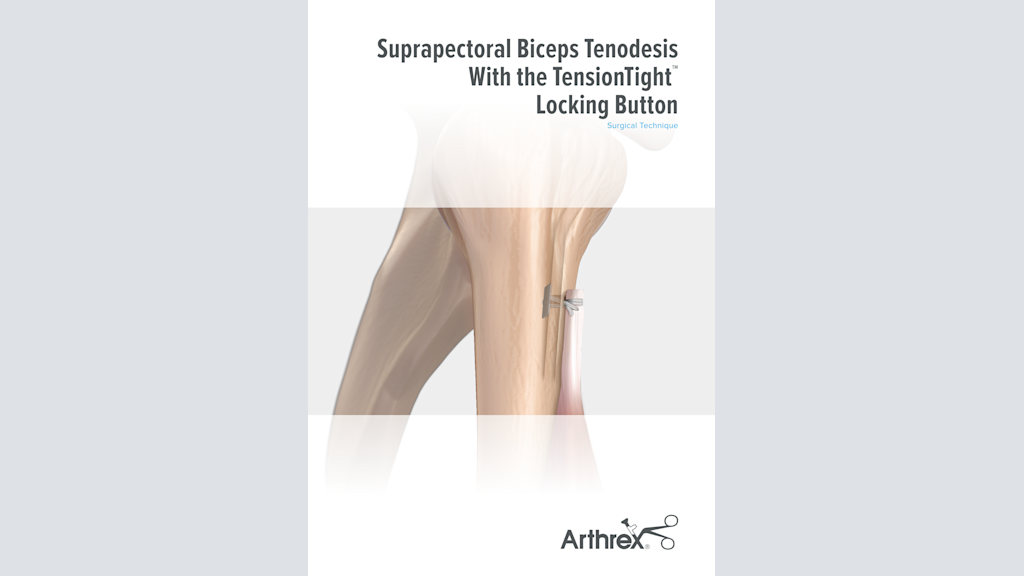 Suprapectoral Biceps Tenodesis With the TensionTight™ Locking Button