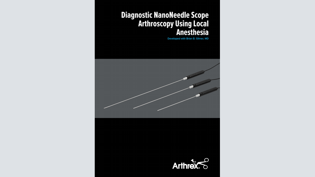 Diagnostic NanoNeedle Scope Arthroscopy Using Local Anesthesia