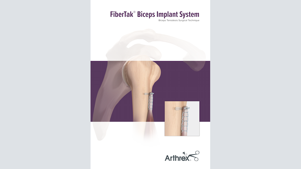 FiberTak® Biceps Implant System