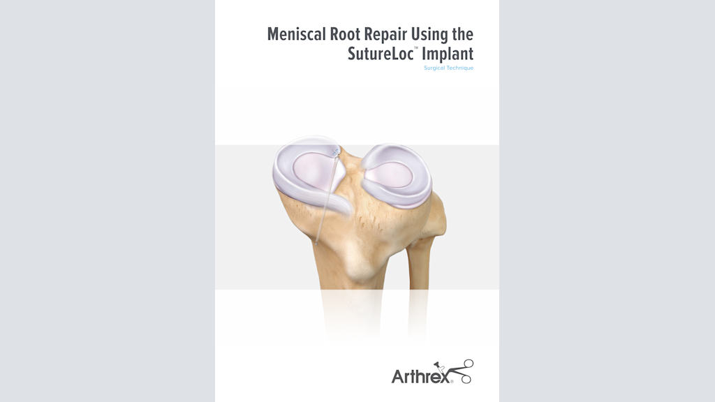 Meniscal Root Repair Using the SutureLoc™  Implant