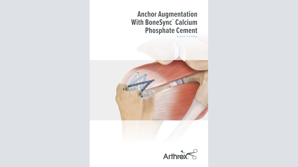 Anchor Augmentation With BoneSync™ Calcium Phosphate Cement