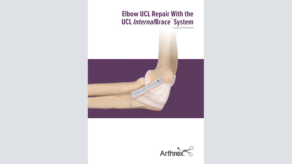 Elbow UCL Repair With the UCL InternalBrace™  System