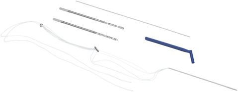 Knotless T-Rope Syndesmosis Repair, Titanium