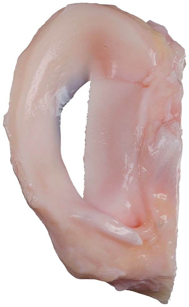 Medial Meniscus, Left