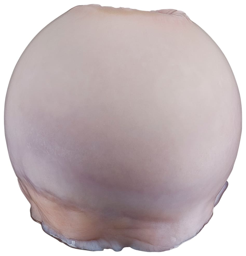 Whole Femoral Condyle, Left