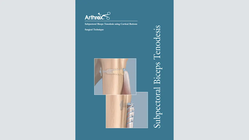 Subpectoral Biceps Tenodesis using Cortical Buttons