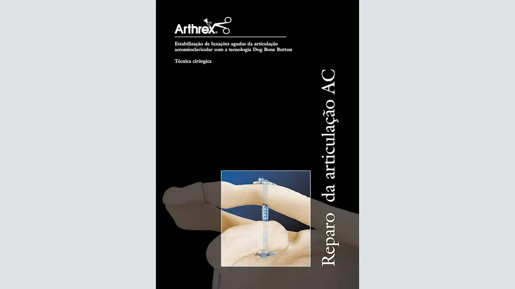 Estabilização de luxações agudas da articulação acromioclavicular com a tecnologia Dog Bone Button