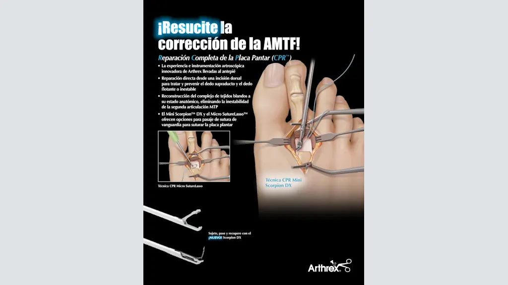 ¡Resucite la corrección de la AMTF! - Reparación Completa de la Placa Pantar (CPR™)