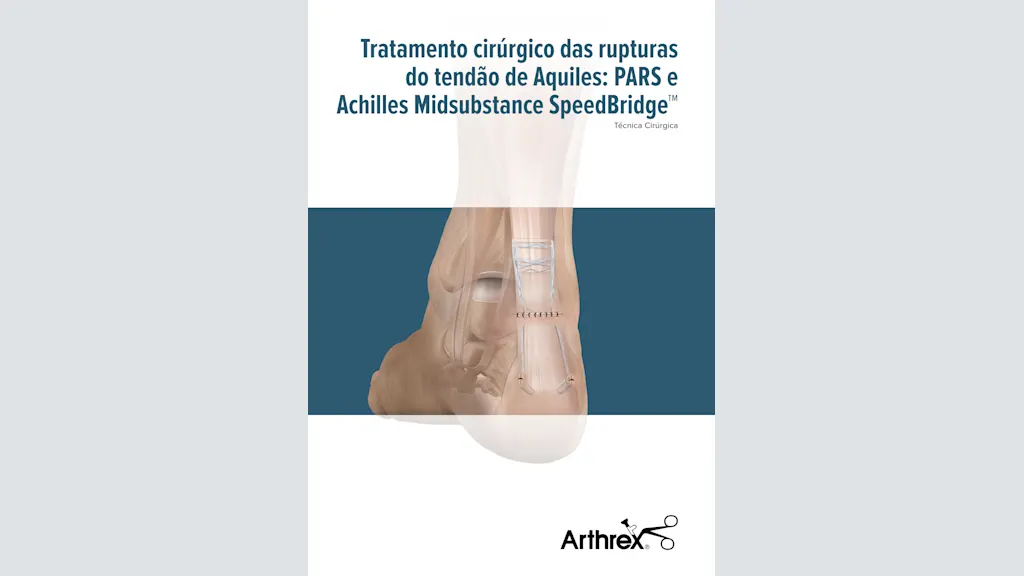 Tratamento cirúrgico das rupturas do tendão de Aquiles: PARS e Achilles Midsubstance SpeedBridge™