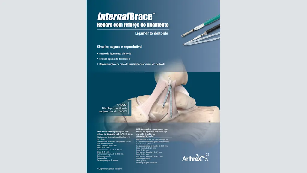 InternalBrace™ Reparo com reforço do ligamento - Ligamento deltoide