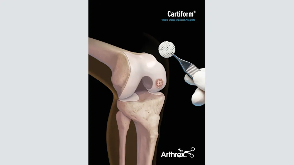 Cartiform® Viable Osteochondral Allograft