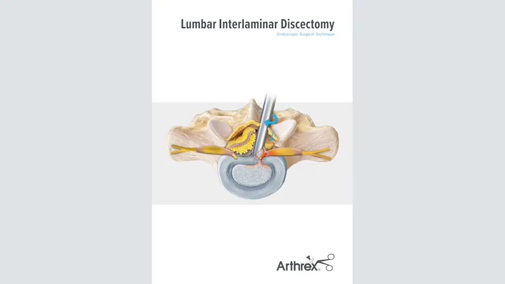 Lumbar Interlaminar Discectomy Endoscopic Surgical Technique