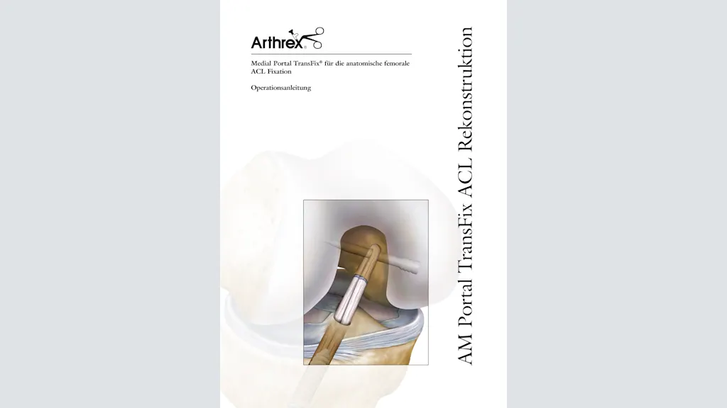 Medial Portal TransFix® für die anatomische femorale ACL Fixation