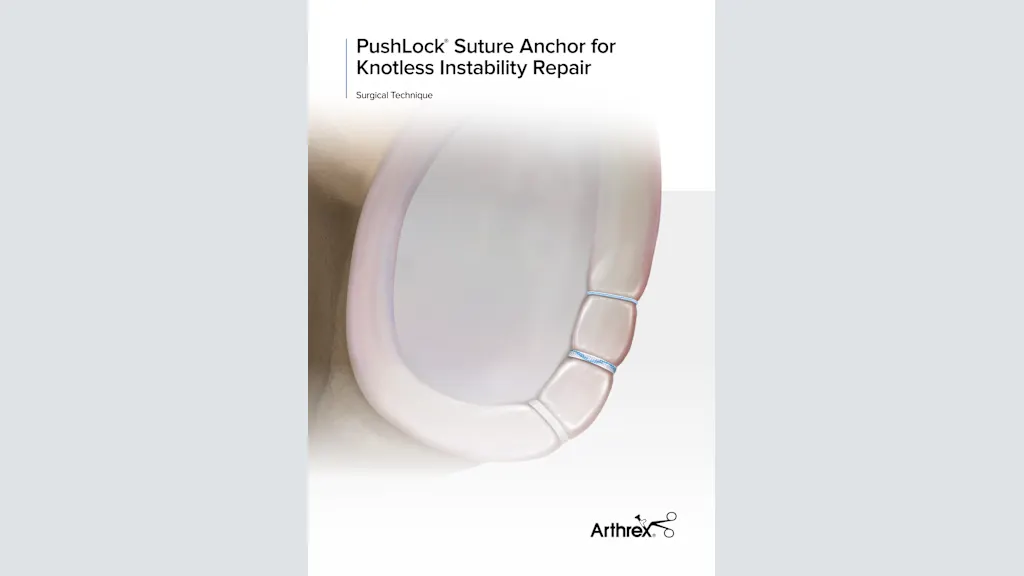 PushLock® Suture Anchor for Knotless Instability Repair