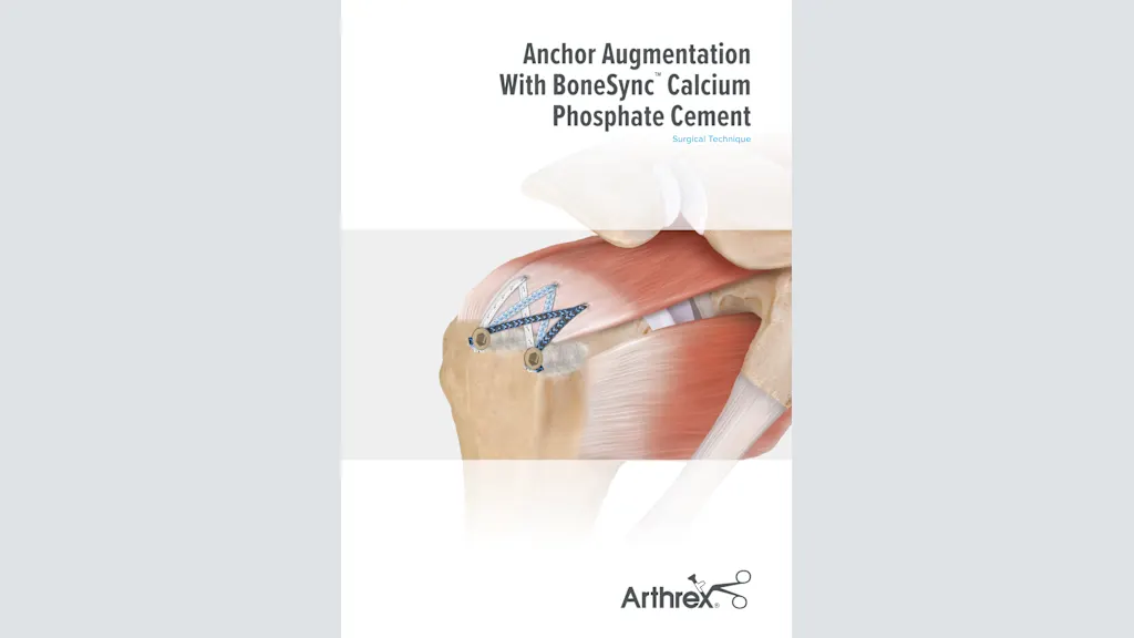 Anchor Augmentation With BoneSync™ Calcium Phosphate Cement
