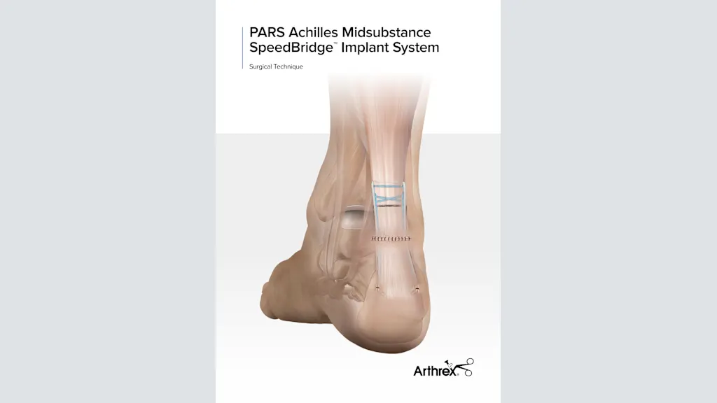 Arthrex - PARS Achilles Midsubstance SpeedBridge™ Implant System