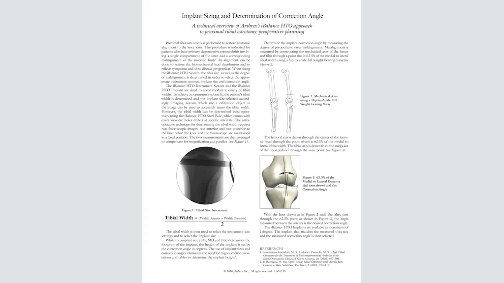 Implant Sizing and Determination of Correction Angle: A technical overview of Arthrex’s iBalance® HTO approach to proximal tibial osteotomy - preoperative planning