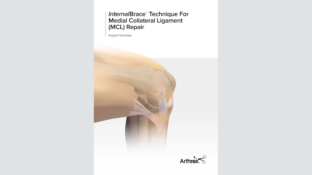 InternalBrace™ Technique For Medial Collateral Ligament (MCL) Repair
