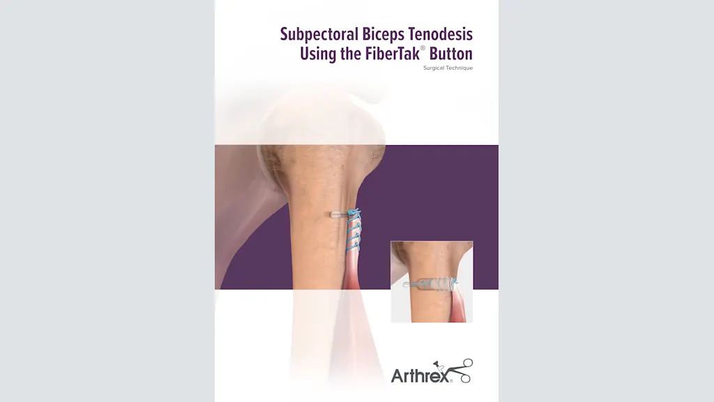 Subpectoral Biceps Tenodesis Using the FiberTak® Button