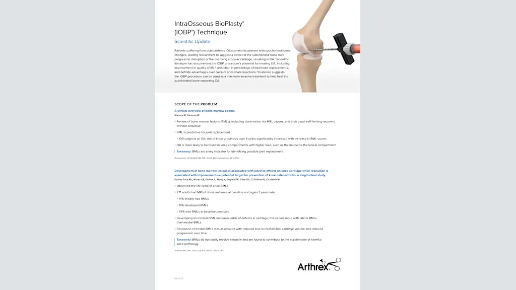 Arthrex - IntraOsseous BioPlasty® (IOBP)-Technik