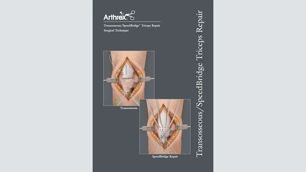 Transosseous/SpeedBridge™ Triceps Repair
