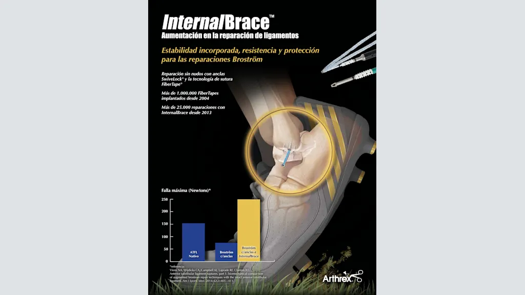 InternalBrace™ - Aumentación en la reparación de ligamentos