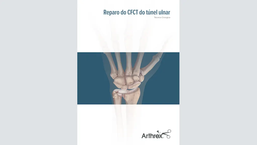Reparo do CFCT através do túnel ulnar