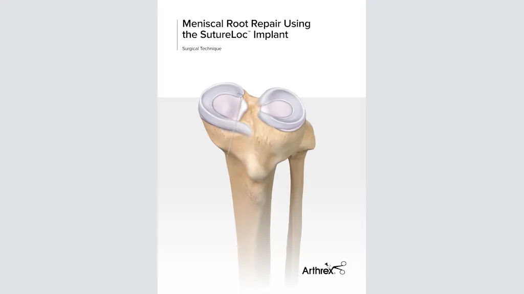 Meniscal Root Repair Using the SutureLoc™  Implant