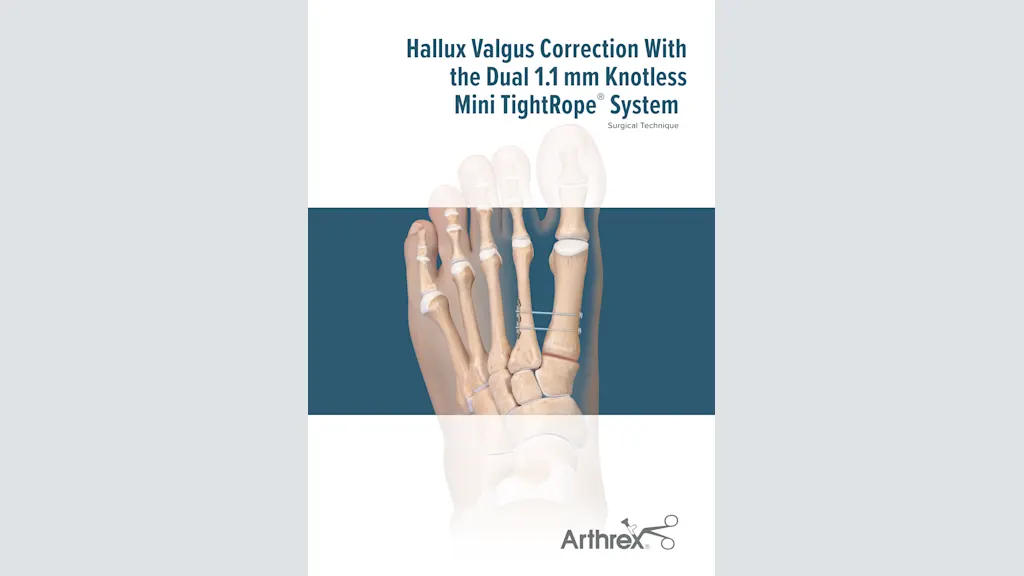 Hallux Valgus Correction With the Dual 1.1 mm Knotless Mini TightRope® System
