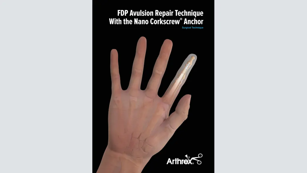 FDP Avulsion Repair Technique With the Nano Corkscrew® Anchor