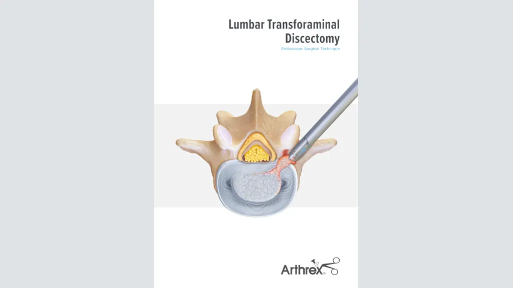 Lumbar Transforaminal Discectomy