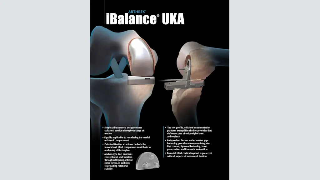 Arthrex® iBalance® UKA