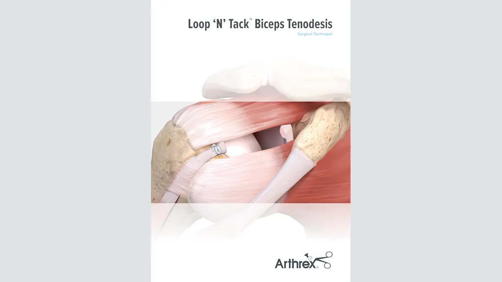 Loop ‘N’ Tack™ Biceps Tenodesis