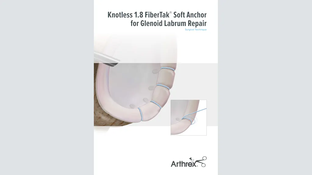 Knotless 1.8 FiberTak® Soft Anchor for Glenoid Labrum Repair